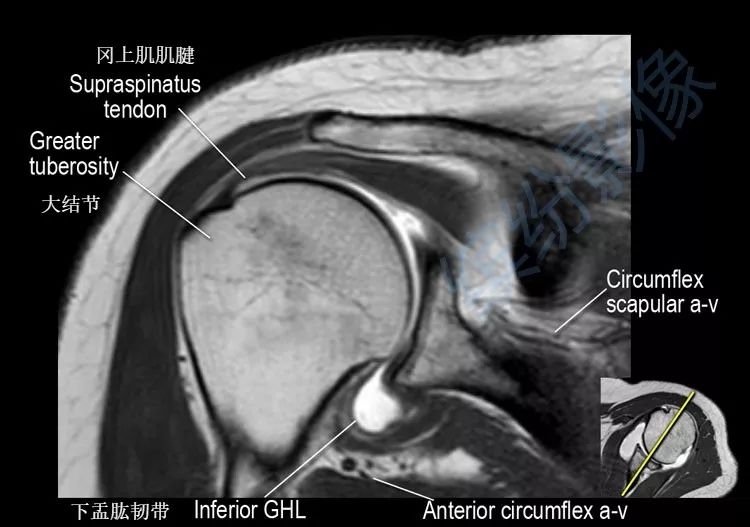 肩关节斜冠状面mr断层解剖