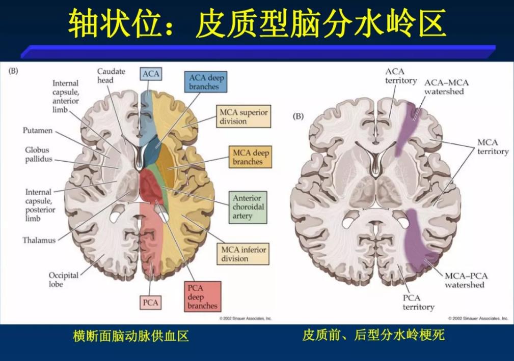 大脑分水岭区图片