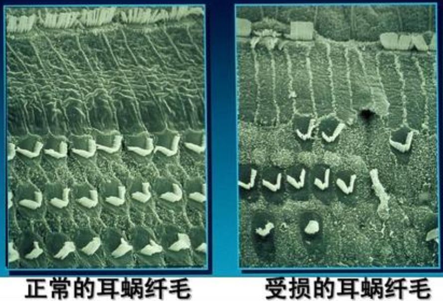 耳朵里有专门的听力"感受器"——耳蜗里的纤毛细胞.