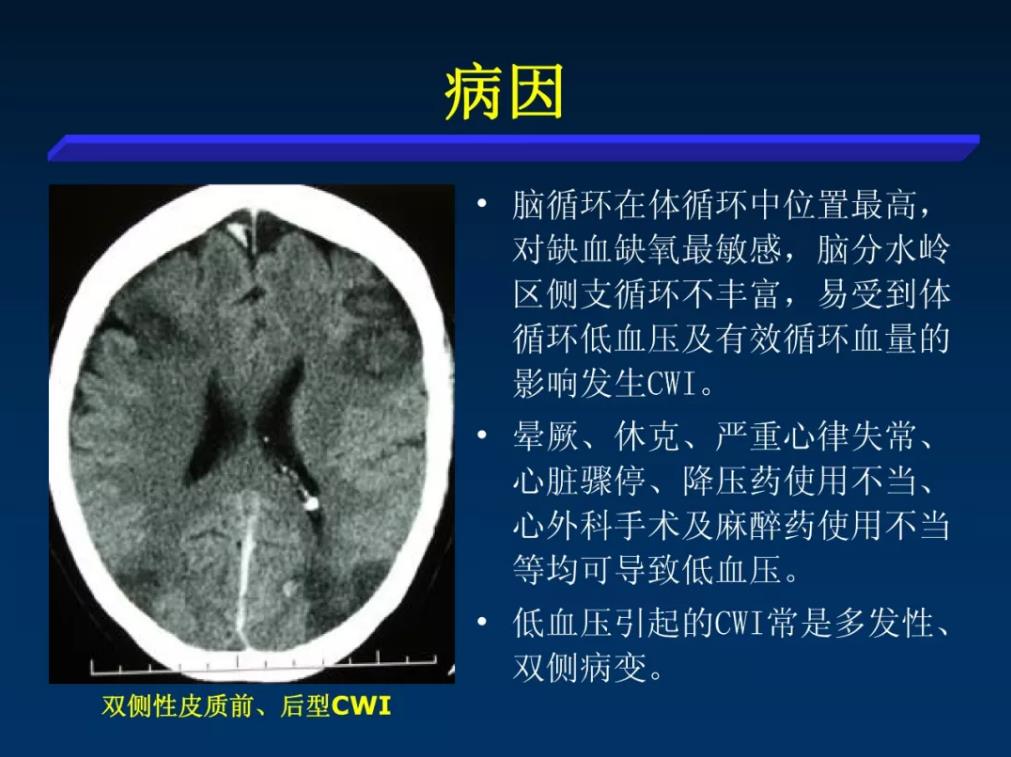 脑血管病之分水岭脑梗死