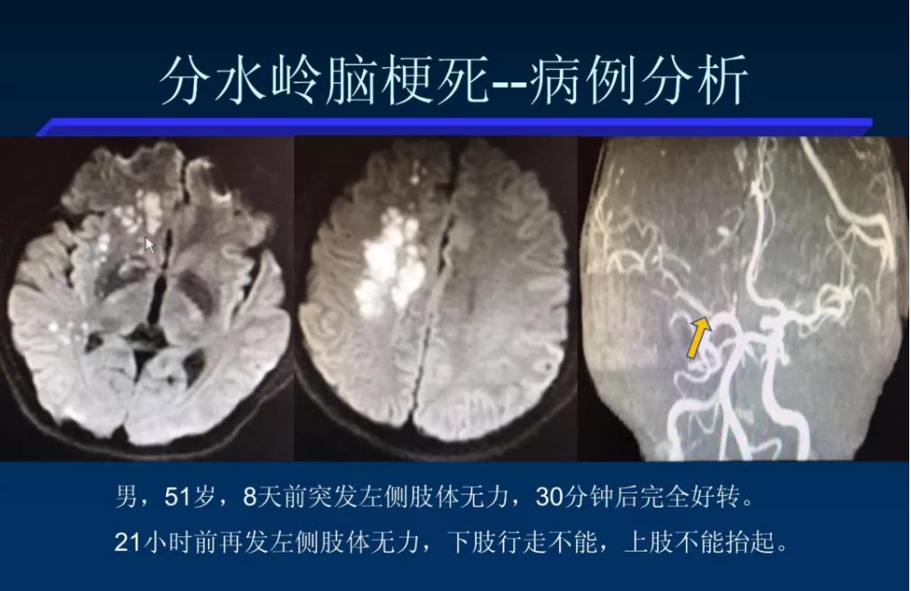 分水岭梗死图片