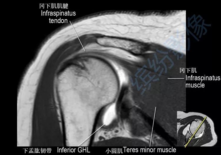 肩关节斜冠状面mr断层解剖
