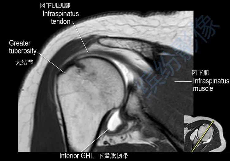 肩关节斜冠状面mr断层解剖