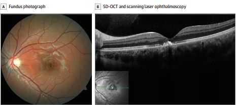 【惟视诊室】年轻男孩出现神秘中心暗点,到底怎么回事?