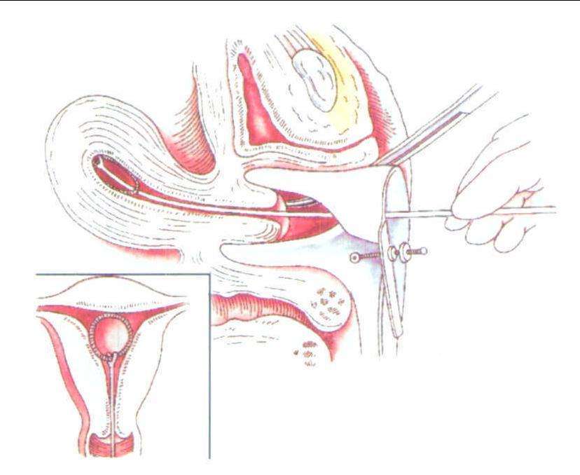 女性结扎照片图解图片