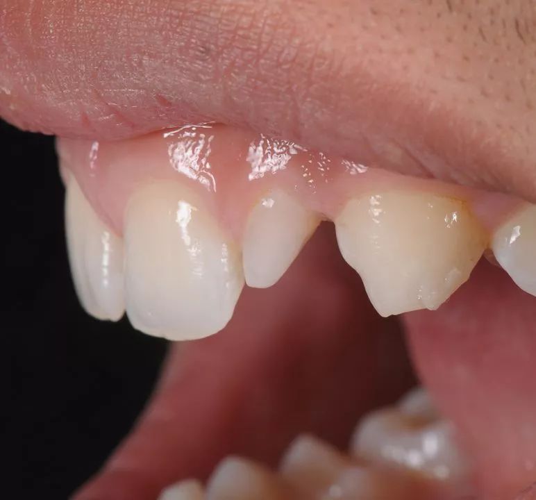 一位16岁的男性患者,临床表现为侧切牙过小牙,且22属于严重病例