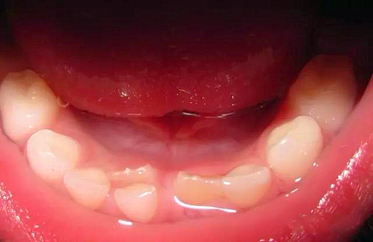 孩子换牙期要注意4大问题否则影响颜值和健康越早知道越好