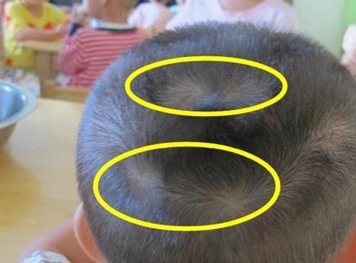 为什么有的孩子头上有"2个旋"?代表什么意思,父母要知道_宝宝