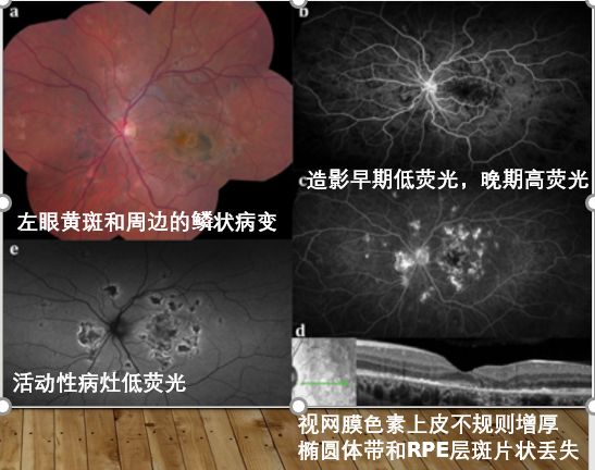 伴视物变形;急性期在黄斑区及附近可见病灶呈暗灰色斑点绕以淡色晕环