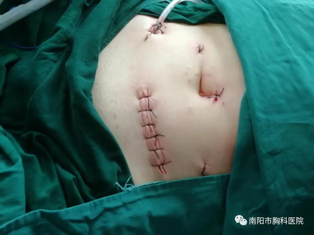 肠梗阻手术切口图图片