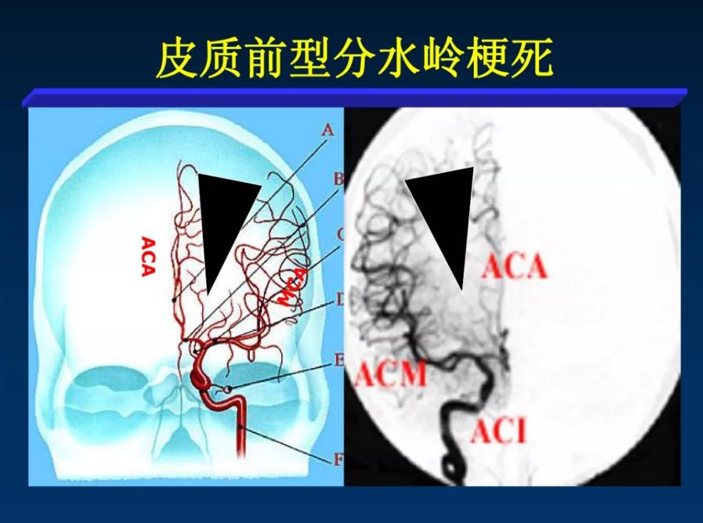 脑血管病之分水岭脑梗死