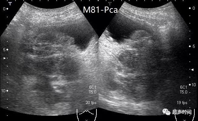 图 3 经腹部超声发现前列腺癌.