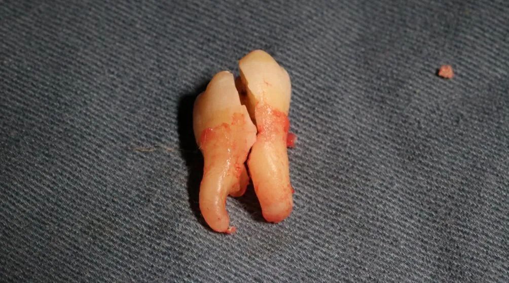 拔一颗智齿要多少钱