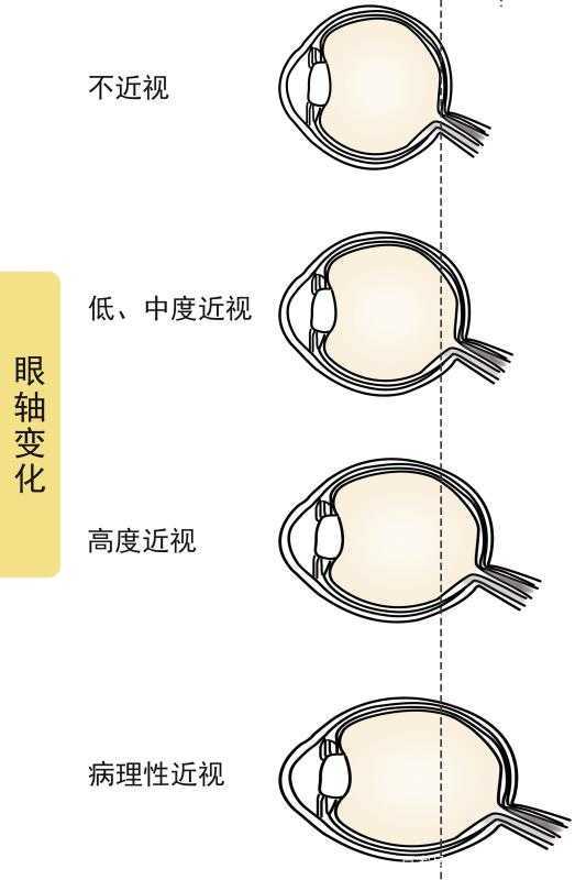 而且出现高度近视引发并发症,导致眼压增高眼睛胀痛,眼轴显著变长