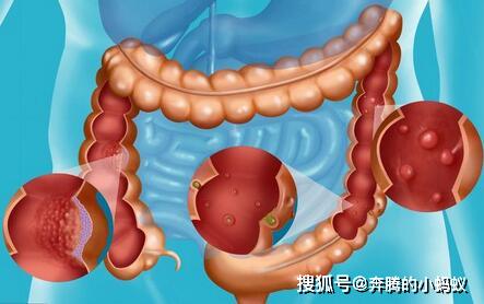 腸息肉可怕嗎