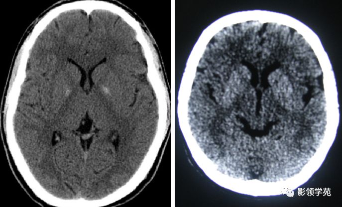 腦實質ct斷層解剖_白質