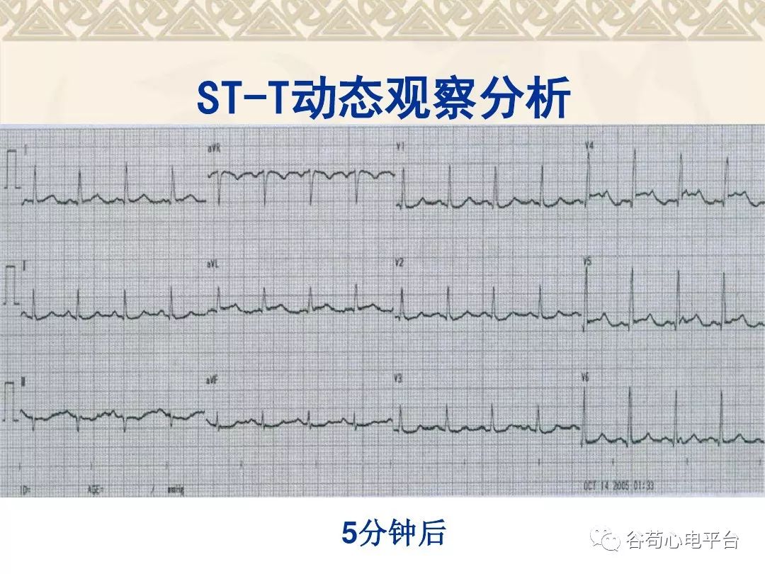 心电图stt改变别害怕图片