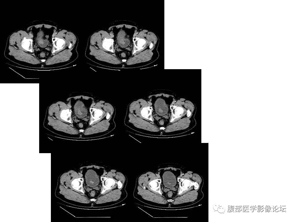 張文坦:膀胱充盈欠佳,頂後壁結節影,邊緣弧形鈣化,基底比較寬,看冠狀