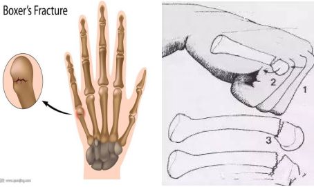 钢琴特长生拳击手骨折专家治疗恢复后赛出好成绩手外科门诊那些事儿9