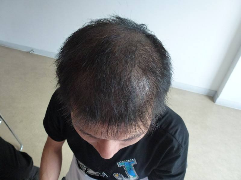 雄激素性脱发 来自搜狐网