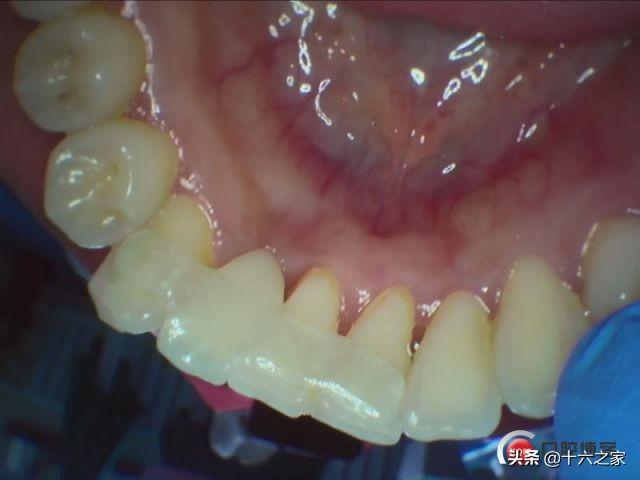 治疗中 粘结桥试戴治疗前患者:女 23岁 右下侧切牙先天性缺失,邻牙无