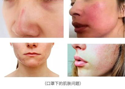 如何解决"口罩脸"出现的肌肤问题?_皮肤
