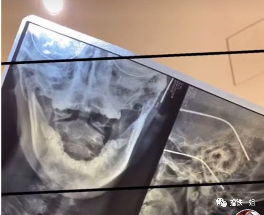 原创张柏芝低头玩手机搞到脖子打石膏有人甩头进医院玩得太过了