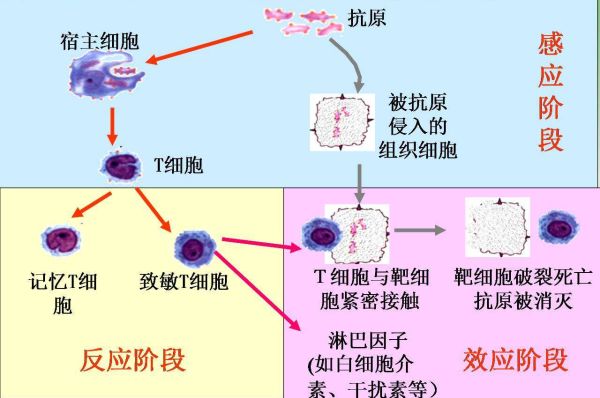 從無菌性炎症認識強直性脊柱炎