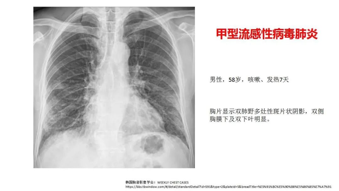 新型冠状病毒肺炎影像学表现及文献复习