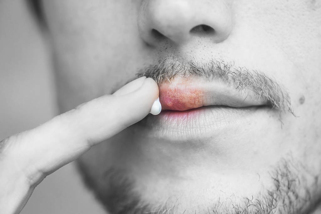 口角炎一般来说能自愈,可口服维生素b2,也可以涂一些润唇膏来缓解症状