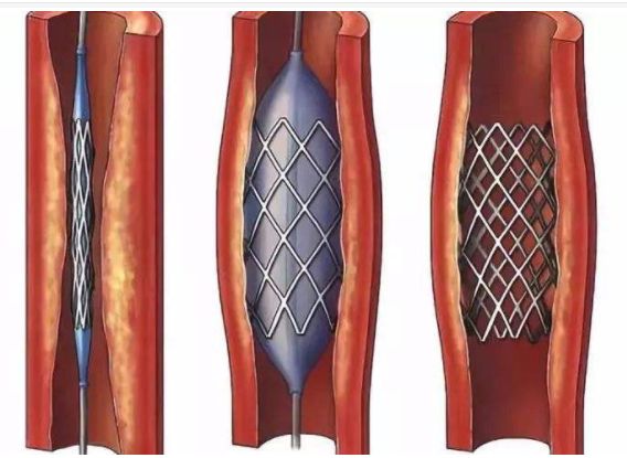 腎功能不全也能做冠脈支架血管長眼睛圈定病變血管減少腎損傷