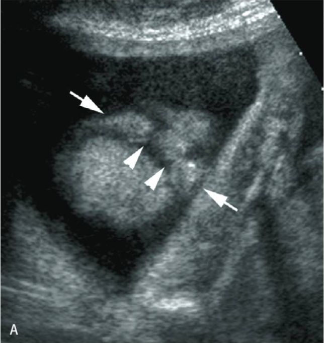 二维三维四维彩超下的唇腭裂胎儿都是怎样的你可能想象不到