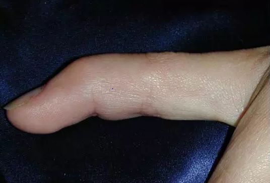 【筋骨堂】戳伤手指,警惕"锤状指"_末节