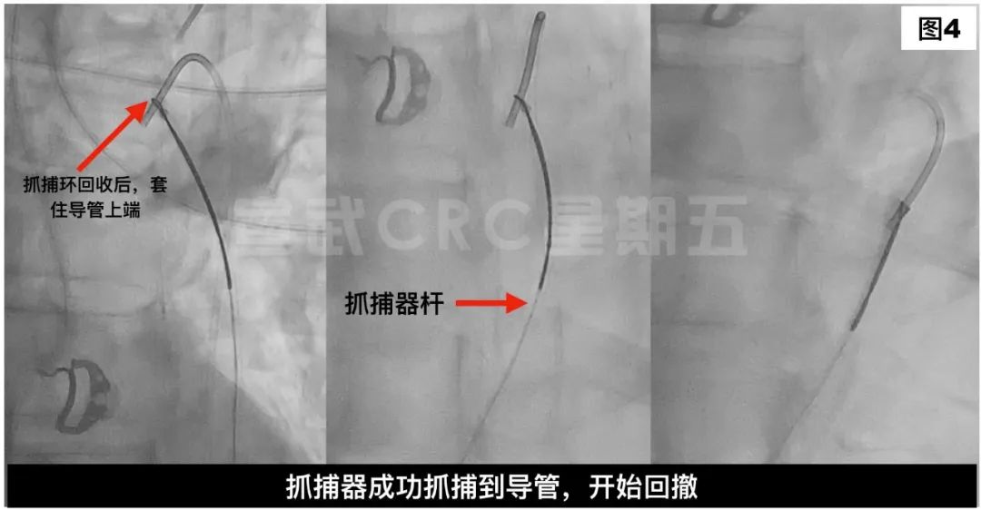宣武星期五丨术中造影导管意外折断怎么办抓捕器来帮忙