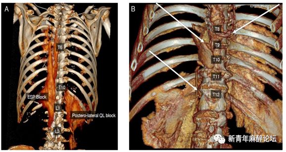 脊肌平面阻滞,右侧实施腰方肌后外侧阻滞,ct三维重建矢状影像后方视图