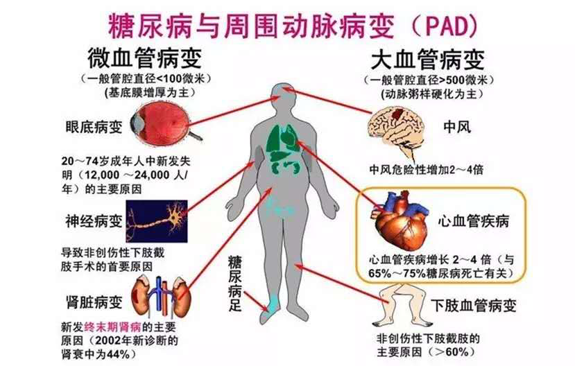 众生复方血栓通胶囊,糖尿病患者为啥要用?