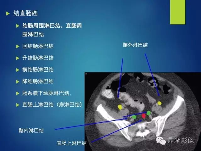 腹部淋巴结分区必点收藏