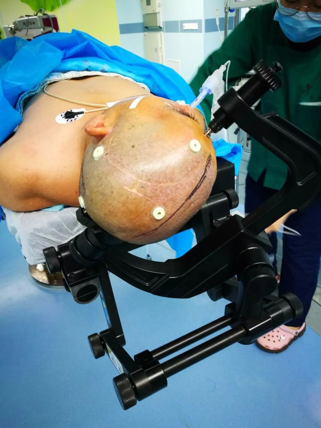 rosa周刊 |专访千佛山医院孙希炎: 首创机器人辅助脑室分流手术 如何