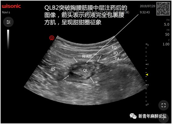 肌後側阻滯(qlb2),有些國外大咖和國內老師質疑是腰段豎脊肌平面阻滯