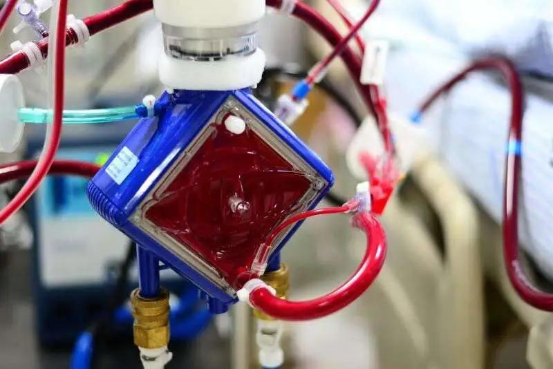 武汉救命机器ecmo被国外垄断救一条人命到底要花多少钱