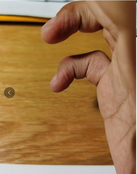 【筋骨堂】戳伤手指,警惕"锤状指"_末节