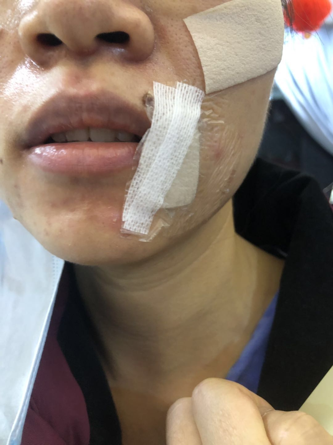 林志娟的额头,两颊,鼻梁都贴着一层像创可贴一样的东西,摘下口罩时,她
