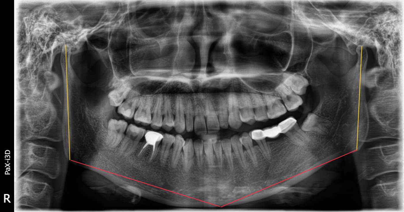 天津隐形矫正刘承医生隐适美治疗骨性偏颌的探讨