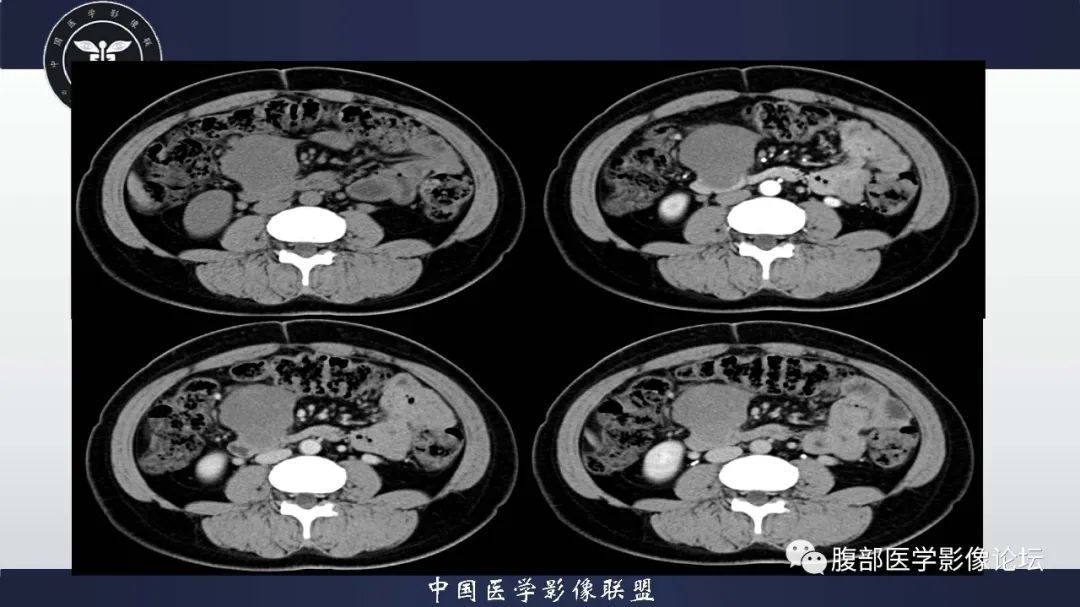 肠系膜丨纤维瘤病