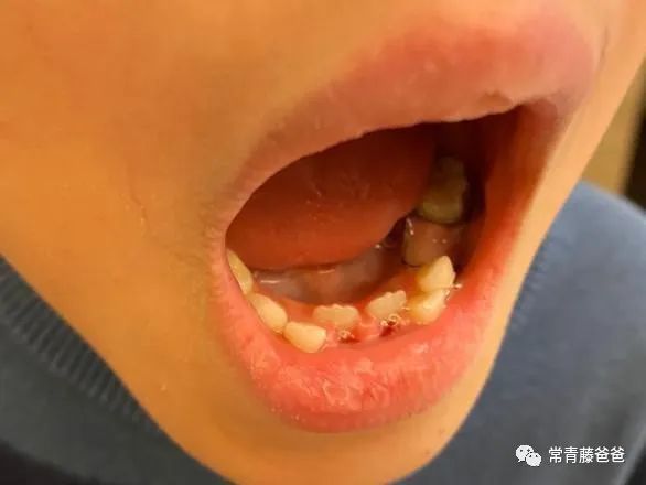 儿子长了"双排牙",爸爸悔不当初:5岁以后还这么干,只会害苦孩子!