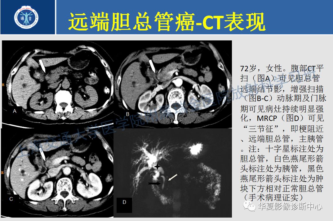 壶腹部癌的影像诊断