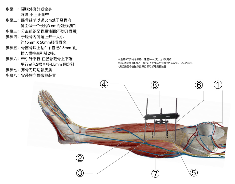 骨搬移手术原理图图片