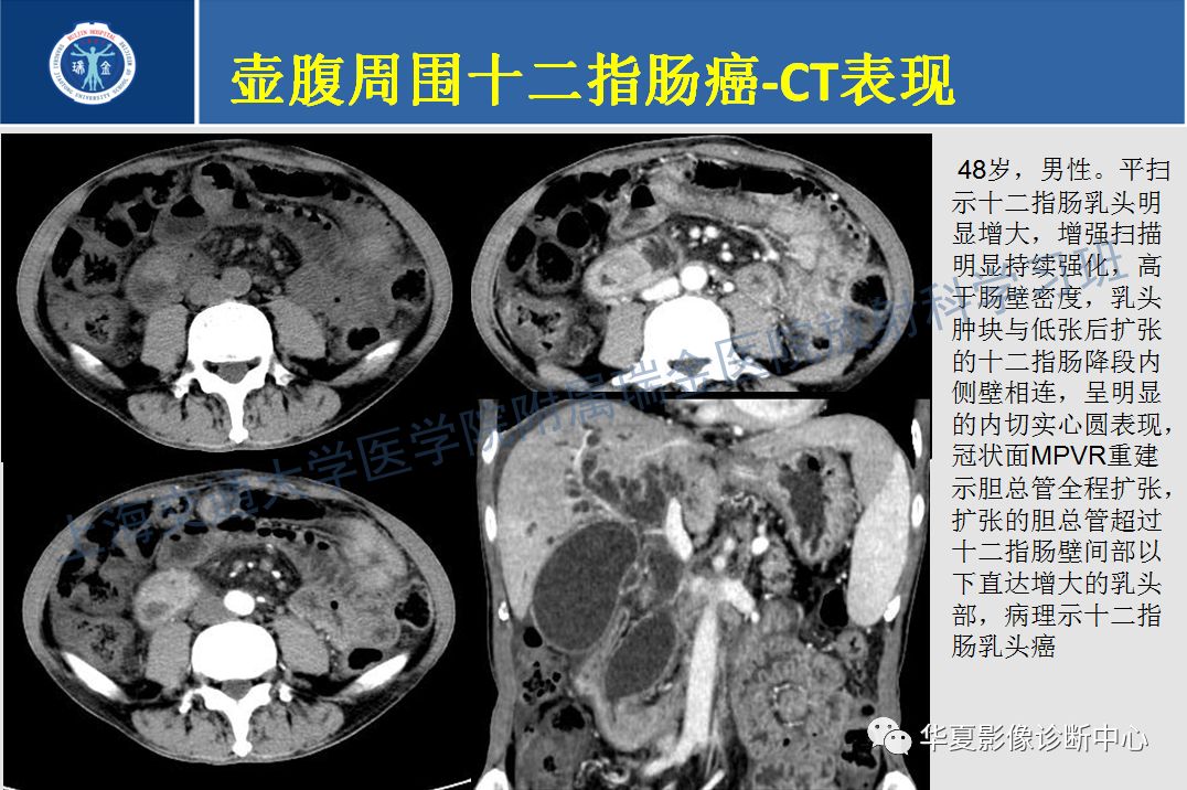 壶腹癌ct图片图片