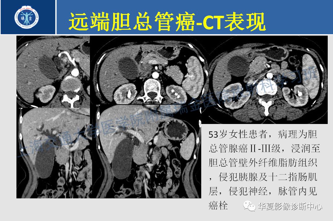 壶腹癌在哪个位置图片图片