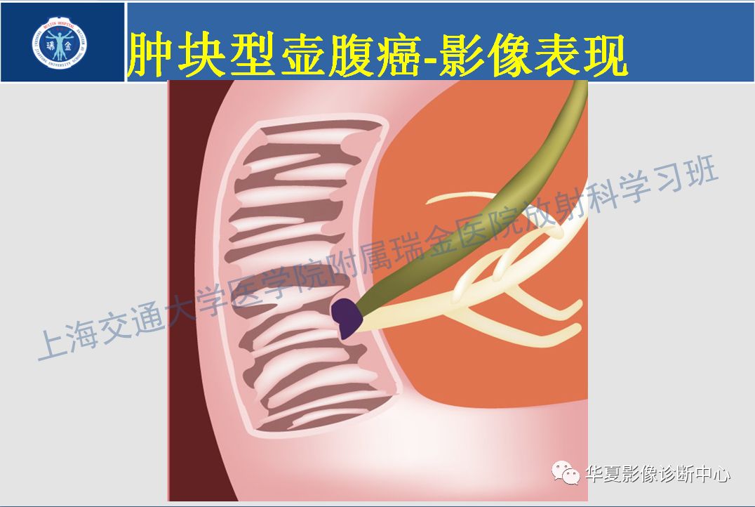 壶腹部癌的影像诊断